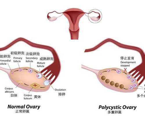 女性绝育新进展：技术革新与决策考量